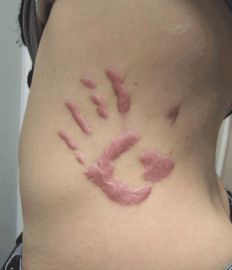 Scarification Hand