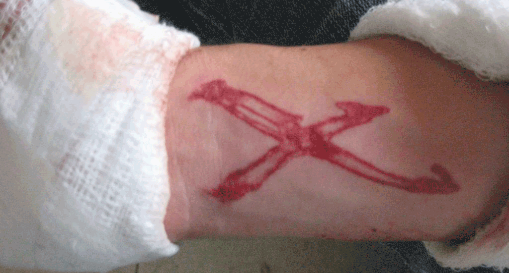 Scarification by a Tattoo Gun