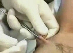 Clitoris Piercing Procedure