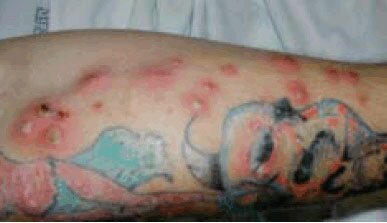 Tattoo MRSA Infection